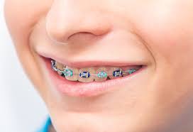 Sep 28, 2020 · the government has said the price of one child is $233,610, but as the saying goes, your mileage may vary. Braces For Children S Teeth Cost Types And More