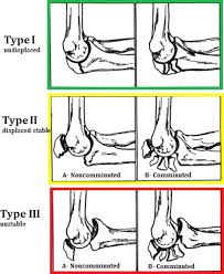 The condition is relatively common and is one of the most frequent types of bursitis. Management Of Type Iib And Iiib Olecranon Fractures Case Series Sciencedirect