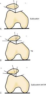 Image result for Patellar Tilt Test
