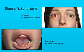 Sicca Syndrome Causes