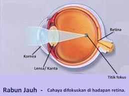 Rabun jauh pada anak merupakan gangguan penglihatan dimana mata tidak mampu melihat obyek jauh dengan jelas. 3 Cara Berkesan Rawat Mata Rabun Jauh Miopia Pusat Rawatan Rabun Mata