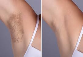 This makes hair impossible to grow back and it's the best choice for those with thick or coarse hair. 9 Effective Ways To Remove Underarm Armpit Hair