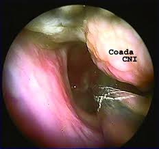 Cat costa o operatie de polipi? Tehnici Chirurgicale In Hipertrofia Cornetelor Nazale Inferioare