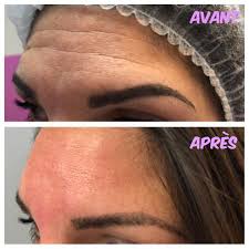 Hyaluron pen sur les lèvres, quelles différences avant après ? 10 Idees De Hyaluronic Pen Traitements De La Peau Esthetique Levre