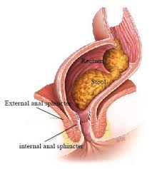 Image result for Fecal Incontinence