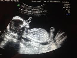 15 Weeks 5 Days Ultrasound Ultrasound Baby Boy Day