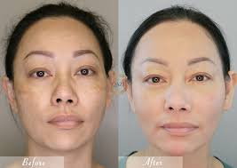 Por qué debería considerar el tratamiento con láser Pico