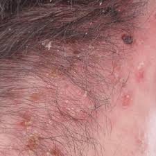 Just remove the part of the hair shaft that is embedded. How To Get Rid Of Ingrown Hairs On Neck How To Get Rid Of Stuff