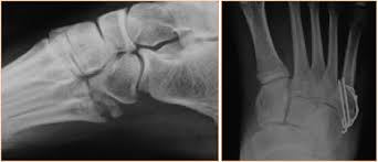Recovery after a fractured femur. A Closer Look At Fixation For Fifth Metatarsal Fractures Podiatry Today