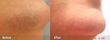 laser hair removal reduction treatments