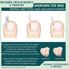 Image result for Toenail Removal