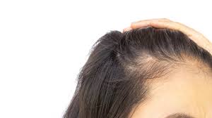 The ahla also recognizes that the pill has been clinically proven to have other health benefits for some women who use them. Does The Iud Cause Hair Loss Iud Alert