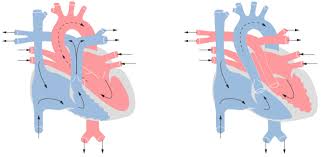 Tetralogy of fallot (tof) encompasses a spectrum of cardiac defects that stem from anterocephalad deviation of the outlet septum, along with abnormal septoparietal trabeculations which contribute to right. Tetralogy Of Fallot Concise Medical Knowledge
