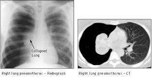 Image result for Pneumothorax