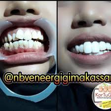 Gigi tak rata tapi putih. Amankah Veneer Di Salon Kecantikan Tukang Gigi Audy Dental