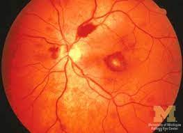 Roth Spot Retinal Photography Eye Health Optometry