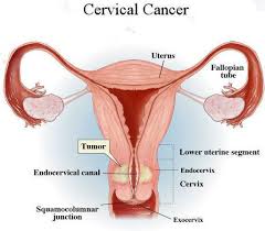 Maybe you would like to learn more about one of these? Cervical Cancer Bluedot Healthcare