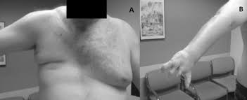 I have been told that i have tuberous breasts. Multiple Cavernous Malformations Presenting In A Patient With Poland Syndrome A Case Report Journal Of Medical Case Reports Full Text