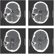 A Case Of Locked In Syndrome Complicated By Central Deafness Nature Reviews Neurology
