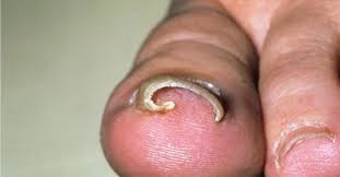 Image result for Akutní zánět nehtového lůžka