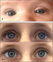 Atypical Horner S Syndrome Frequency Features And Aetiology In A Paediatric Population Eye