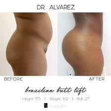 In subscribing to our newsletter by entering your email address you confirm you are over the age of 18 (or have obtained your parent’s/guardian’s permission to subscribe) and agree to. Mia Aesthetics Before And After Results From A Bbl Facebook