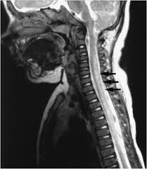 Image result for Myelitis