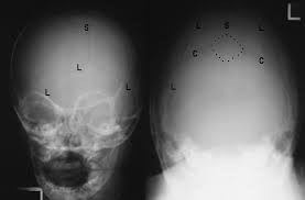 Image result for Skull XRay