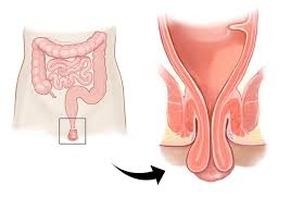 Image result for Rectal prolapse