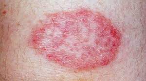 Getty images) &quot;the muscle weakness is progressive, and tends to occur in and around the hips and shoulders. Leukemia Rash Pictures Signs And Symptoms Everyday Health