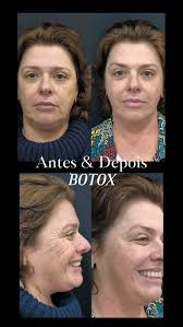 O poder da toxina botulínica, pensada de forma estratégica para essa  paciente ✨,