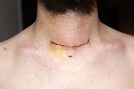 Thyroid cancer is a disease that doesn't usually manifest signs or symptoms in its early stages. Managing Tsh Levels After Total Thyroidectomy Oncology Nurse Advisor