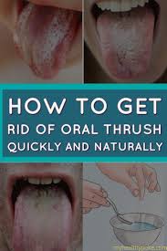 6 Tips From Grandmother To Combat Oral Thrush My Healthy Poke Oral Thrush Remedies Oral Thrush Treatment Oral
