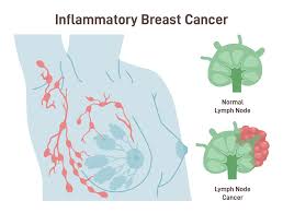 Image result for Inflammatory breast cancer
