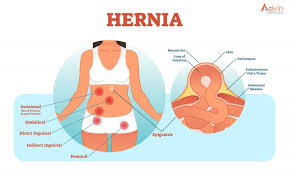 Image result for Hernia Reduction