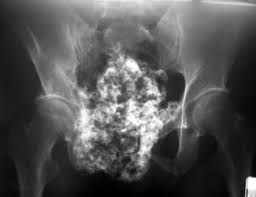 Image result for Chondrosarcoma