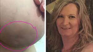Lumps can be a sign of cysts or a fibrocystic breast condition, both of which are treatable. Woman S Breast Cancer Warning Sign Photo Goes Viral Abc7 New York