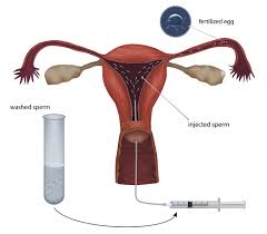 Iui-Ready And Ici-Ready Donor Sperm: What'S The Difference?