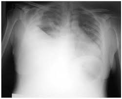 Blunting of the lateral costophrenic angle usually requires. Cardiac Tamponade Secondary To Pleural Effusion In Hepatopulmonary Syndrome Revista Espanola De Cardiologia