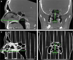 Nasal congestion can be more than merely annoying; Three Dimensional Printing Of The Nasal Cavities For Clinical Experiments Scientific Reports
