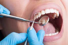 The following are some of the most common indications of how to tell if you have a cavity. Not Sure If You Have A Cavity Here S How To Check Padden Dental