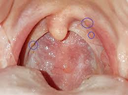 Los talleres comienzan su trayectoria profesional en madrid, zona mirasierra y vaguada, prestando todo tipo de servicios relacionados con el. Papilloma Dell Ugola Cause Papilloma Virus Hpv Simptome La Cancerul De Col Uterin Papilloma Ugola Cause