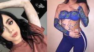 Berjalan adalah cara terbaik untuk meredakan otot pinggang. Apa Itu Vitiligo Hilangnya Pigmen Warna Penyebab Kulit Tubuh Menjadi Belang Tribun Batam