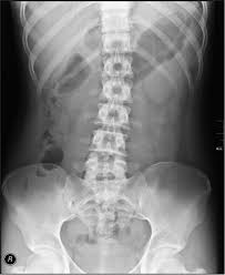 Kublaicoin is listed on 1 exchanges with a sum of 1 active markets. Abdominal X Ray Wikipedia