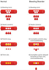 treating hemophilia living with hemophilia