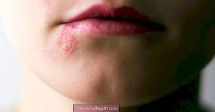Walau bagaimanapun, virus varicella zoster menular sehingga virus dapat disebarkan melalui kontak dengan lepuh sirap. Kayap Gejala Gambar Rawatan Dan Banyak Lagi Dermatologi 2021