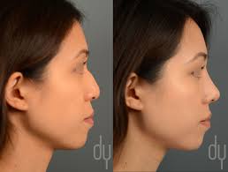 Beverly Hills Rhinoplasty Specialist Dr Donald Yoo Performed A Primary Asian Rhinoplasty And Upper Blepharoplasty Rhinoplasty Facial Plastic Surgery Nose Job