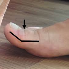 Toenail Blisters 7 Causes 7 Fixes Toe Nails Toe Blister Claw Toe