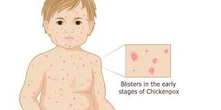 Image result for chickenpox