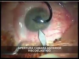 Goze Saplanmis Bir Cismi Cikarmak Icin Bakin Aldigi Ilim Ile Doktor Nasil Mudahale Uyguluyor Youtube